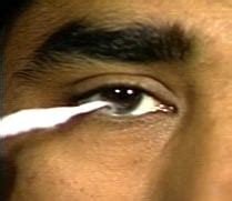 corneal-cotton or saline drop will blink test|sterile corneal reflex test.